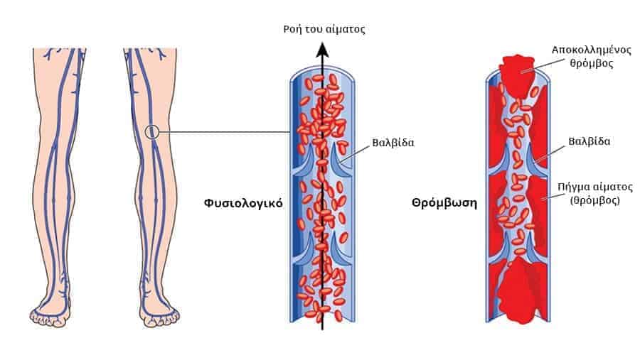 &Theta;&rho;ό&mu;&beta;&omega;&sigma;&eta;: &Kappa;&alpha;&iota;&nu;&omicron;&tau;ό&mu;&omicron;&sigmaf; &phi;&omega;&tau;&omicron;&theta;&epsilon;&rho;&alpha;&pi;&epsilon;ί&alpha; &delta;&iota;&alpha;&lambda;ύ&epsilon;&iota; &theta;&rho;ό&mu;&beta;&omicron;&upsilon;&sigmaf; &kappa;&alpha;&iota; &sigma;ώ&zeta;&epsilon;&iota; &zeta;&omega;έ&sigmaf;
